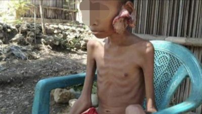 Bocah Penderita Kanker Asal Kabupaten Kupang Ditolak Pihak Rumah Sakit